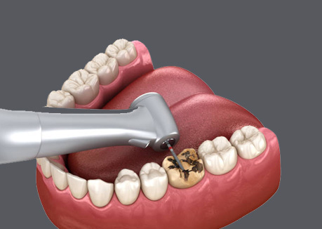 Cavity Treatment Procedure: Decay Removal Banner
