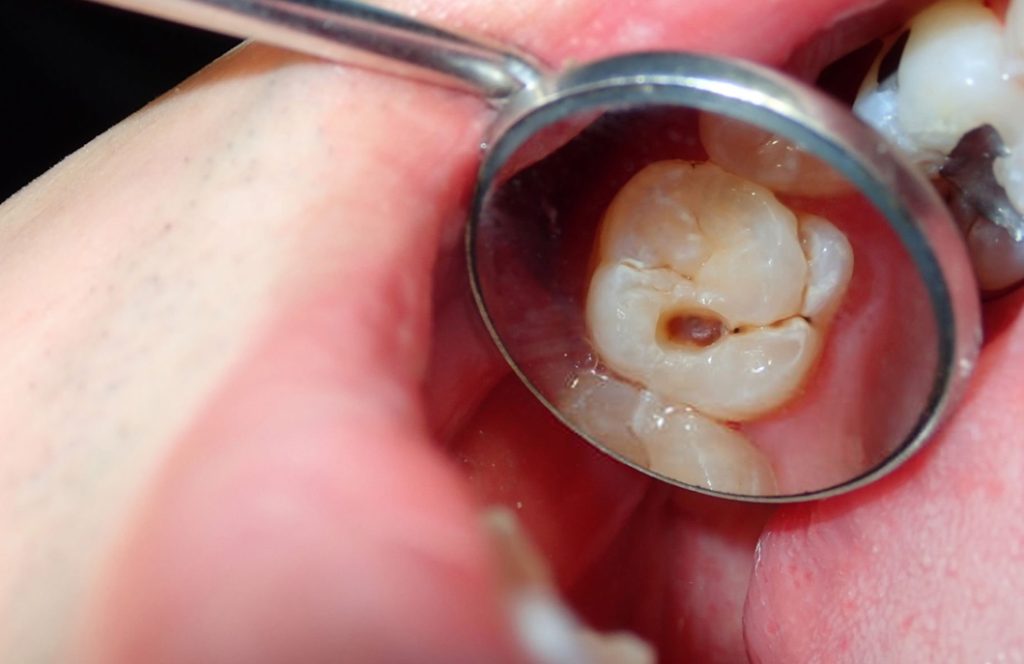 What Is a Cavity? Banner