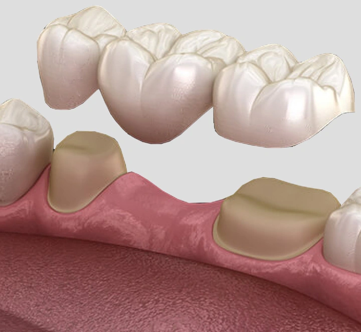 What Are Dental Bridges Banner