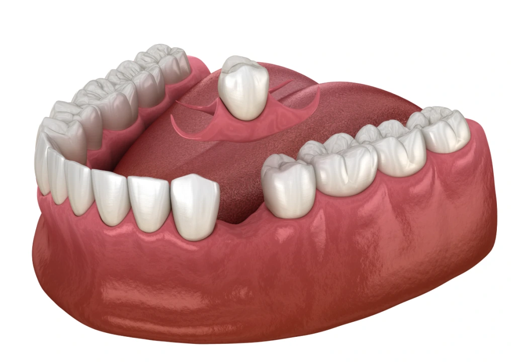 Immediate Dentures Bannner