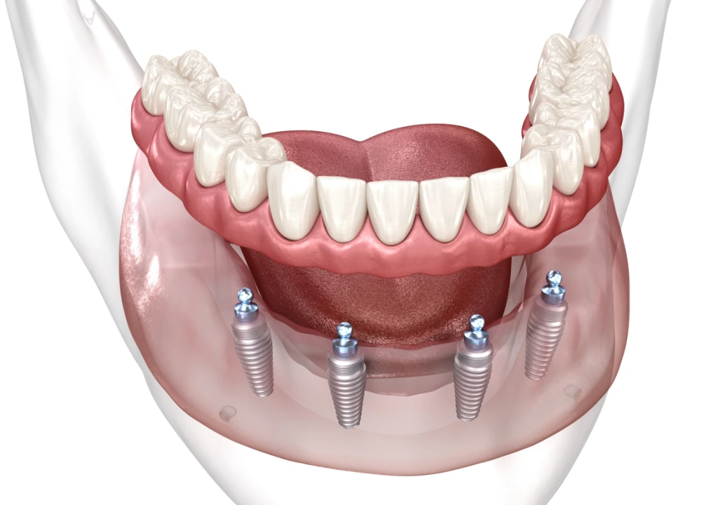 Implant Dentures Banner