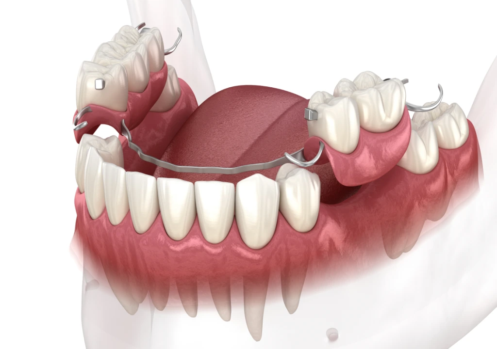Partial Dentures Banner