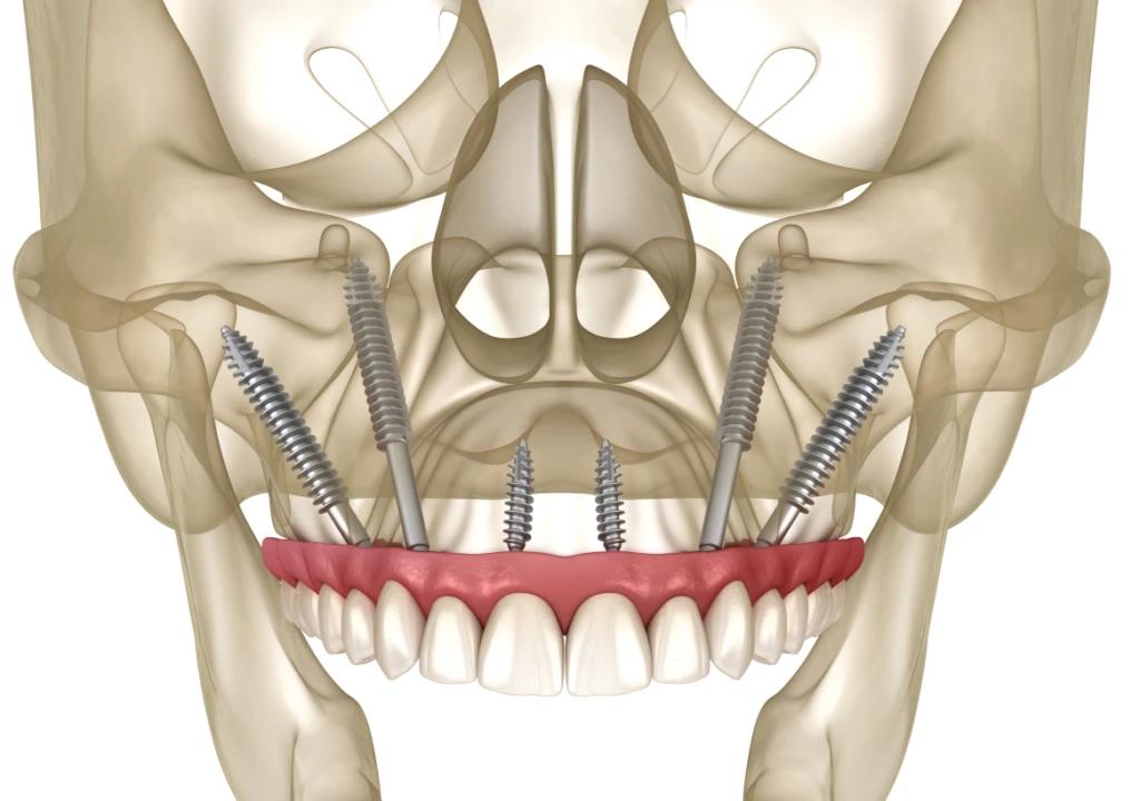 Types of Dental Implants banner