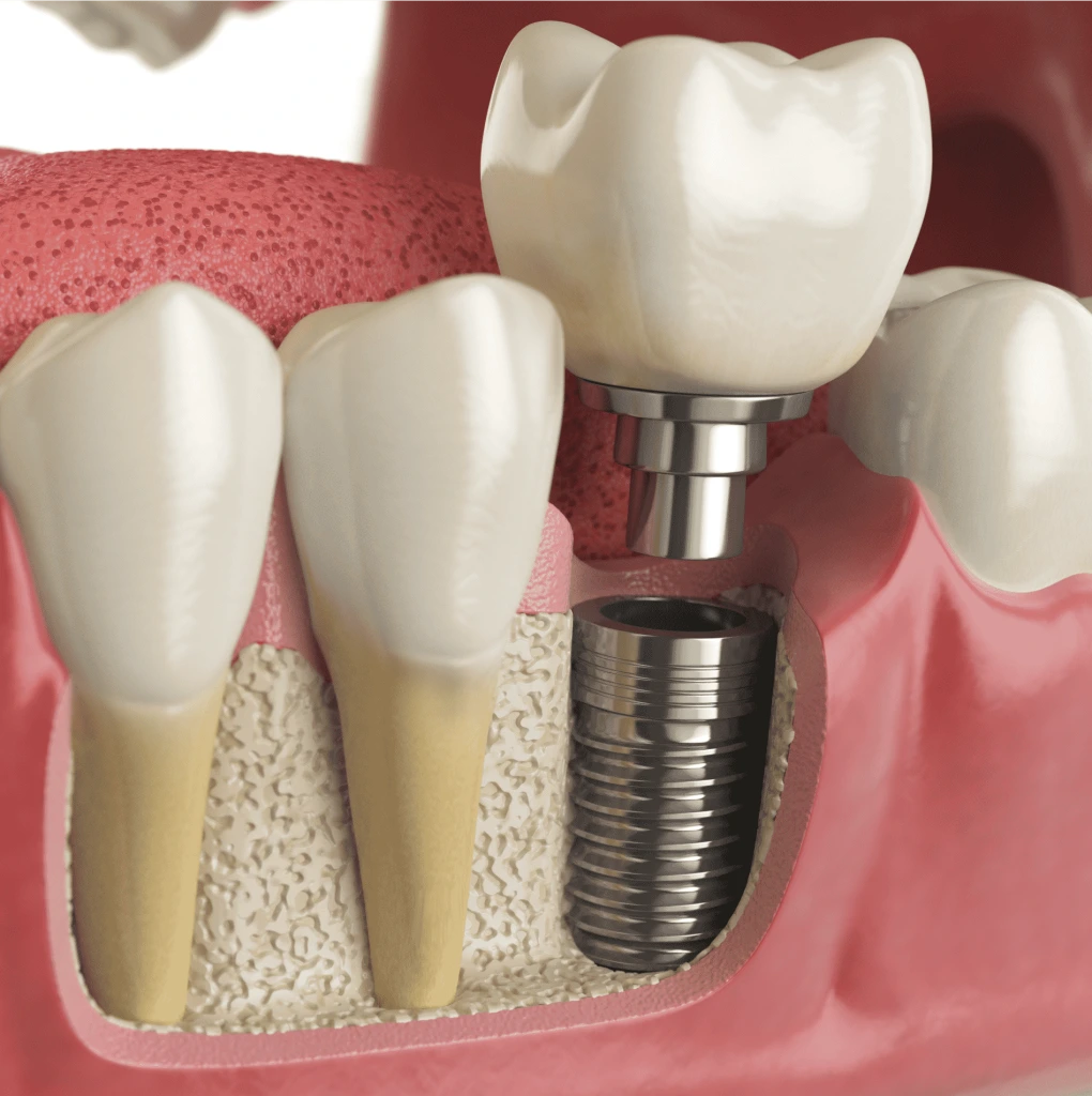 What Is a Dental Implant Surgery? Banner