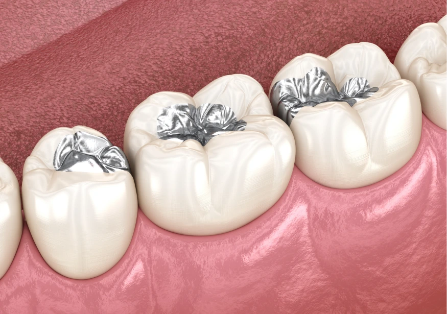 Types of Dental Fillings Banner