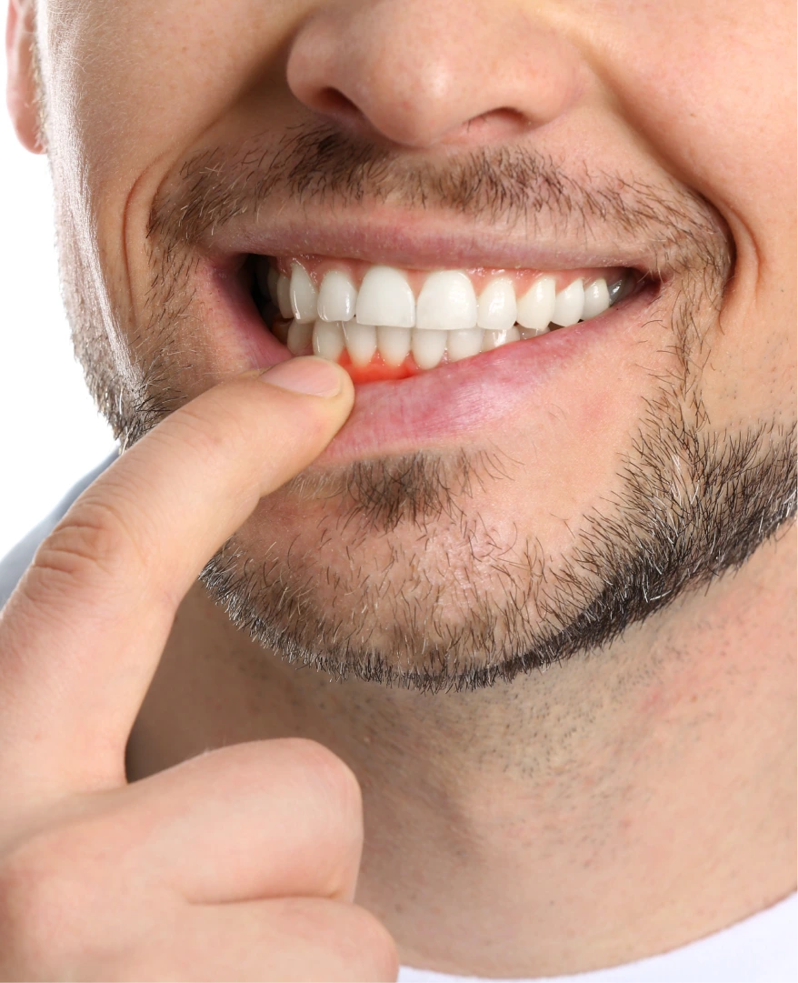 What Is Gum Disease? Banner